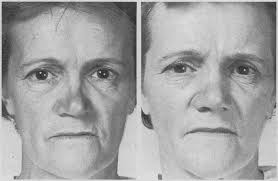 Split Rib Graft for Alar Collapse