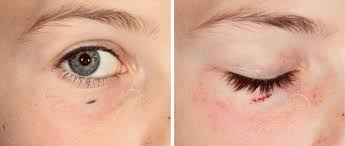 Image result for Blue Nevus