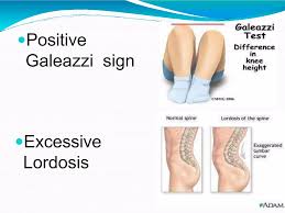 Image result for Galeazzi Sign