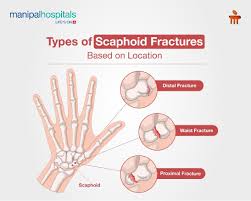 Image result for Scaphoid Fracture Signs