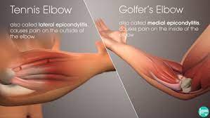 Related online courses on physioplus. Epicondylitis And Climbing New Treatment Possibilities