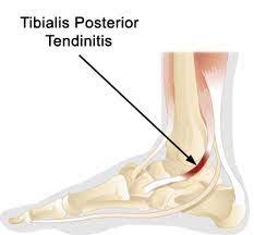 Tibialis Posterior Tendinopathy Physio Works