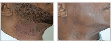 Lasers produce intense light that is directed at the pigment of the hair follicle called melanin. Laser Hair Removal Columbus Aesthetic Plastic Surgery