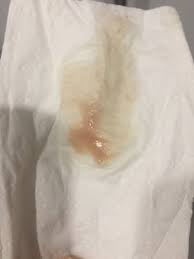 Jan 17, 2018 · if your nasal discharge is any color other than clear, it could be a sign of an infection. Blood In Discharge 4 Weeks Pregnant Novocom Top