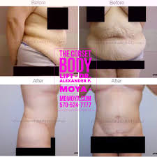 Pin On After Major Weight Loss