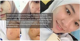 Makin remaja, dewasa, jerawat susut, tapi kesan dari jerawat iaitu parut jerawat taknak pergi! Dari Muka Breakout Teruk Hingga Flawless Dalam Masa 2 Bulan Gadis Ini Cuma Gunakan Produk Dari Drugstore Je Siakap Keli News