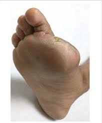 Image result for toe amputation