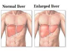 Most people don't have signs and symptoms in the early stages of primary liver cancer. Warning Signs And Symptoms Of Liver Cancer Most People Ignore
