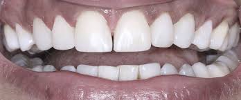 There are lots of dental issues that bonding can correct. Bonding Direkte Asthetische Zahnkorrekturen Asthetische Zahnheilkunde Frankfurt