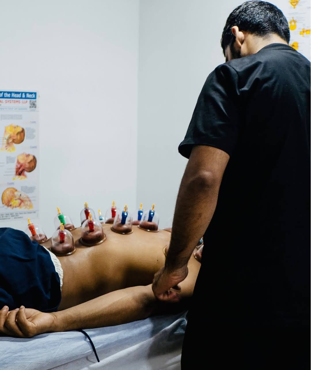 Cupping Therapy product image