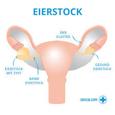 Polycystic ovary syndrome (pcos) is an endocrine disorder that affects women of reproductive age, but its symptoms may. Polyzistisches Ovar Syndrom Pco Symptome Und Behandlung Dr Seb