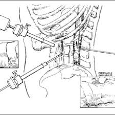 Pdf Laparoscopic Assisted Lumboperitoneal Shunt A Simplified Technique