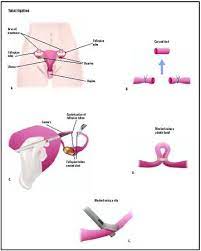 Tubal Ligation Procedure Recovery Blood Tube Pain Complications Time Infection