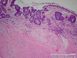 Image result for Radiation Colitis