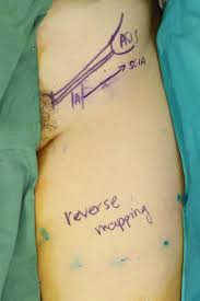 Cancer can appear in the lymph nodes in two ways: Donor Limb Assessment After Vascularized Groin Lymph Node Transfer For The Treatment Of Breast Cancer Related Lymphedema Clinical And Lymphoscintigraphy Findings Journal Of Plastic Reconstructive Aesthetic Surgery