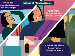 How Long Does Mono Last? The 3 Stages Of Mononucleosis