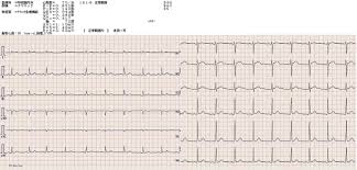 Canter ce, simpson ke.diagnosis and treatment of myocarditis in children in the current era. A Case Of Asthma Complicated Influenza Myocarditis Springerlink