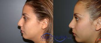 Rhinoplasty Before and After Photos