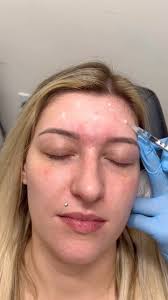 💉🅑 🅞 🅣 🅞 🅧 💉, What is it? Botox is a non-surgical solution to smooth  fine lines and wrinkles. It helps with wrinkles around the eyes, forehead,  jaw and mouth. After moving the same muscle over the ...