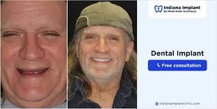 Affordable Alternatives to Dental Implants