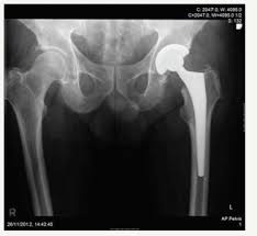 Polyethylene Liner Dissociation With The Depuy Pinnacle Cup A Report Of 6 Cases Crimsonpublishers Com