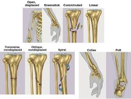 Types Of Fractures In Human Body Koibana Info Types Of Bones Fracture Pictures Types Of Fractures