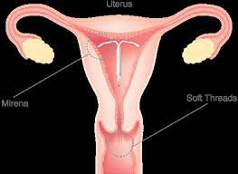 Meaning of iud in english. Preston Family Medical Offers Mirena Or Copper Iud And Implanon