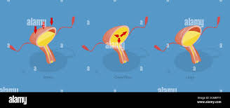 Image result for Overflow Incontinence