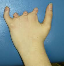 Klicken sie hier um mehr informationen zu dieser webseite zu erhalten. Poland Syndrome Hand Orthobullets
