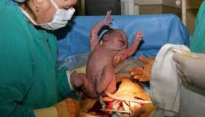 Der geplante kaiserschnitt wird in der regel ungefähr in der 38. Placenta Praevia Oft Geht Es Nicht Ohne Kaiserschnitt