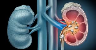Medical Management Of Kidney Stones Georgia Urology