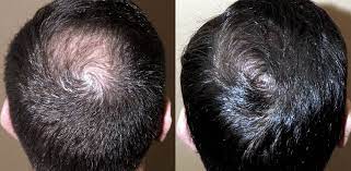 Nonostante si tratti di un fenomeno del tutto fisiologico, . Alopecia E Calvizie La Perdita Dei Capelli E Colpa Della Cellule Staminali Inattive Hairclinic