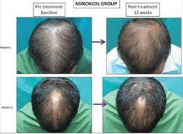 Before using microneedling for hair growth, ensure your scalp and remaining hair are wet. Microneedling For Hair Growth Is It Effective Hairguard