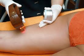 laser hair removal side effects hayes