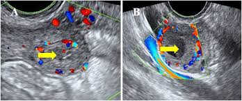 Image result for corpus luteum sonography)