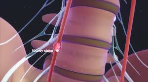Each kidney contains up to a million functioning units called nephrons. Flank Pain Kidney And Urinary Tract Disorders Msd Manual Consumer Version