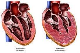 Hypertrophic Cardiomyopathy Heartupdate Com Hypertrophic Cardiomyopathy Enlarged Heart Circulatory System Diseases