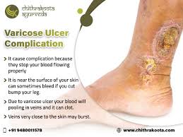Varicose Ulcer Complication Ayurveda Ayurvedic Therapy Varicose Ulcer