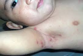Image result for scabies human bites