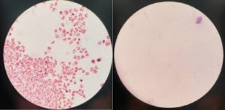 Image result for CSF Culture