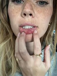 What is worse, the ear lobe or the lips?