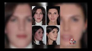 About Face: Facial Feminization