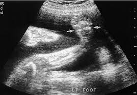 We have correlated the accuracy of the prenatal findings in 281 ultrasound surveys with the physical findings after birth. Clubfoot At 22 Second Weeks Gestation The Forefoot Arrows Is Download Scientific Diagram