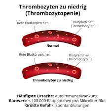 Als student ist man oft knapp bei kasse. Thrombozyten Zu Niedrig Thrombozytopenie Thrombopenie