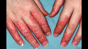 Nummular eczema, usually associated with dry skin and occur on the outside of the legs, hands and arms. Natural Eczema Cure Remedy How To Get Rid Of Dry Hands Youtube