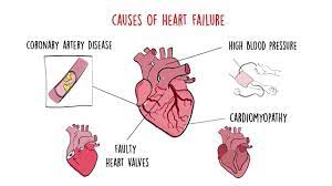 Being obese is also a cause of sleep apnea and can cause cardiomyopathy. World Heart Federation Roadmap On Heart Failure Youtube