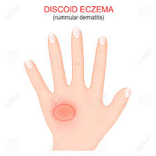Image result for Eczema nummulare