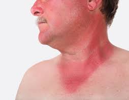 Image result for Sunburn
