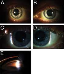 Hallucinogenic drugs, in particular the dissociatives. Man Reports Acute Onset Of Blurred Tunnel Vision