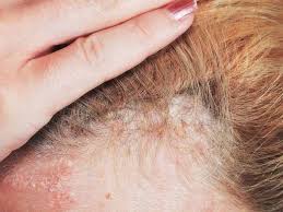 Mix the baking soda & water to your dry or even to your wet hair by pouring some of the content to the roots of the hair and all over the scalp. Learn To Do Baking Soda Hair Wash Like A Professional Lewigs